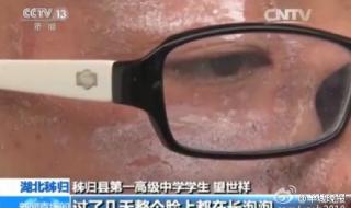 隐翅虫咬人后图片